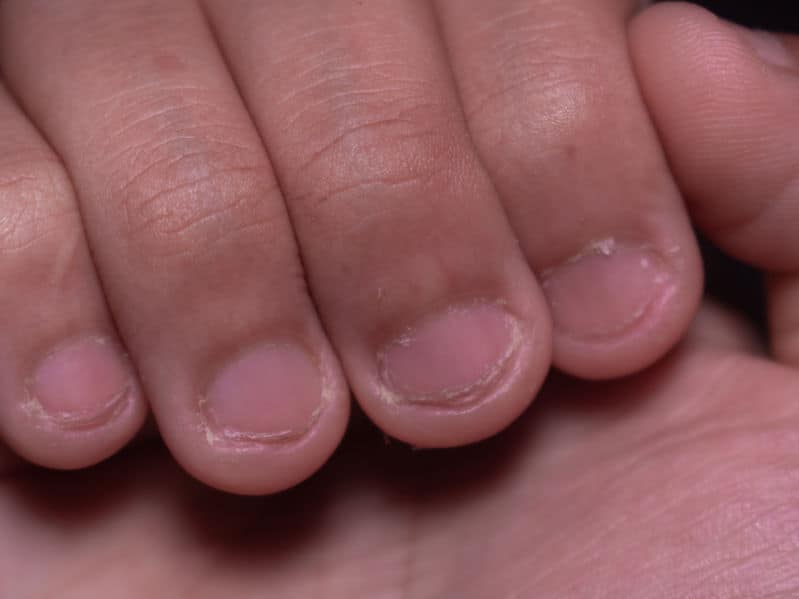 The degree of nail biting matters