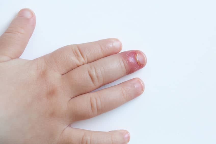 Can You Get A Nail Biting Infection? (Paronychia)