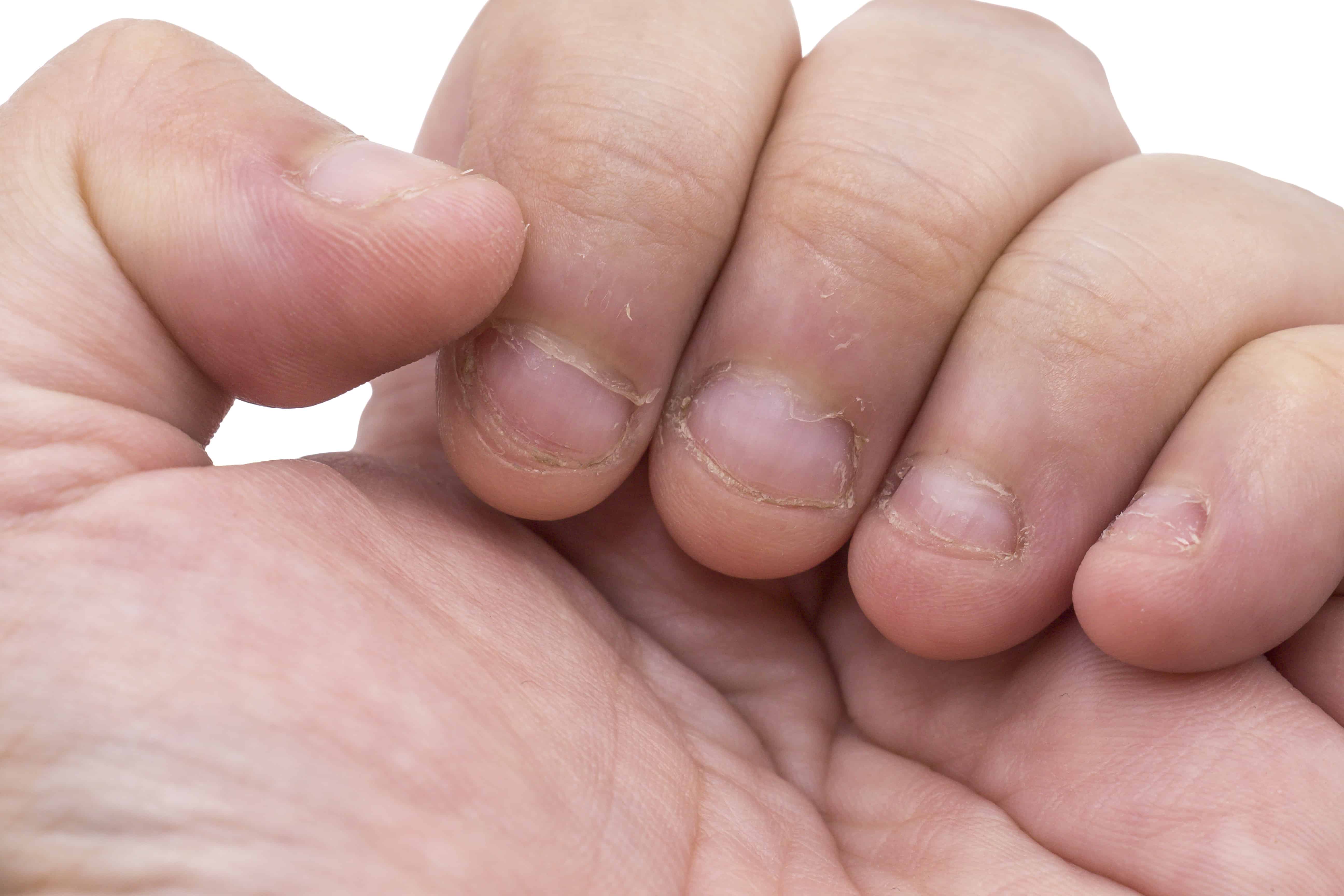 What Is The Technical Term For Bitten Nails