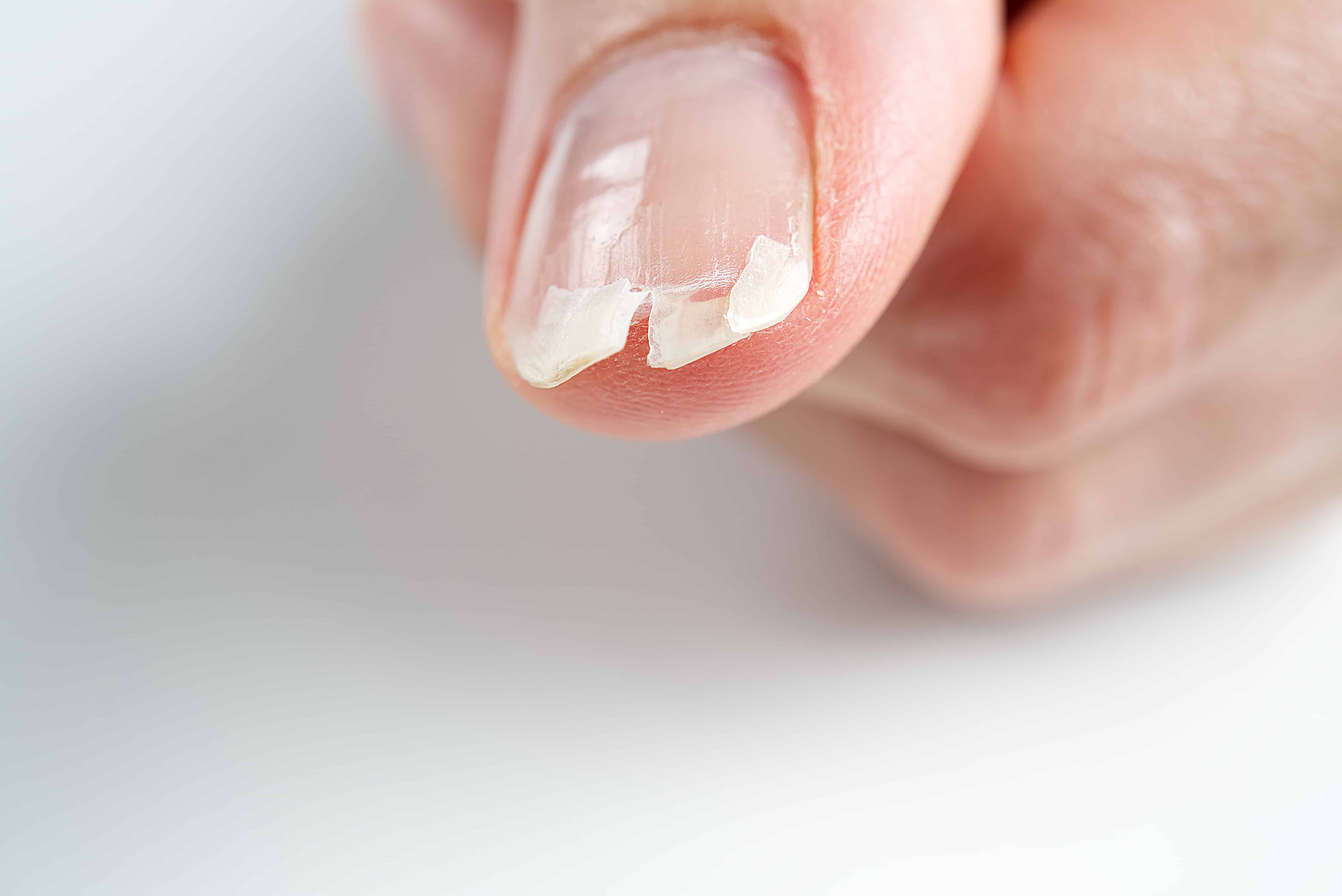 Is Nail Brittleness Vitamin Deficiency Related? End Nail Biting