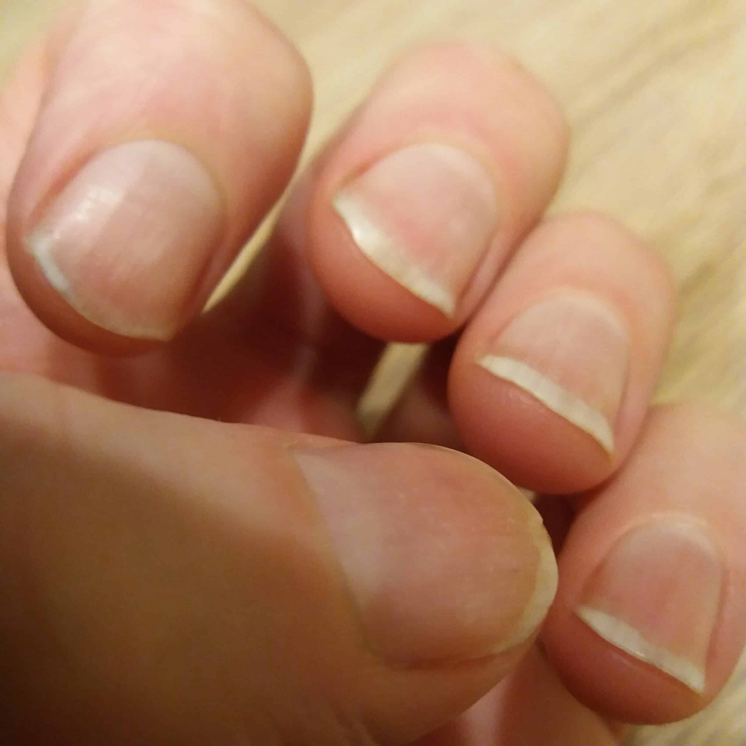 Nail Biting Relapse: How To Break The Nail Biting Habit